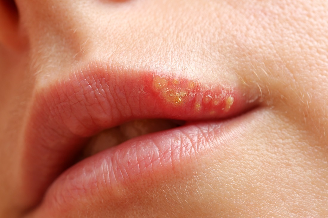 Resultado de imagem para Gel criado na USP promete acabar com feridas de herpes na boca em um dia